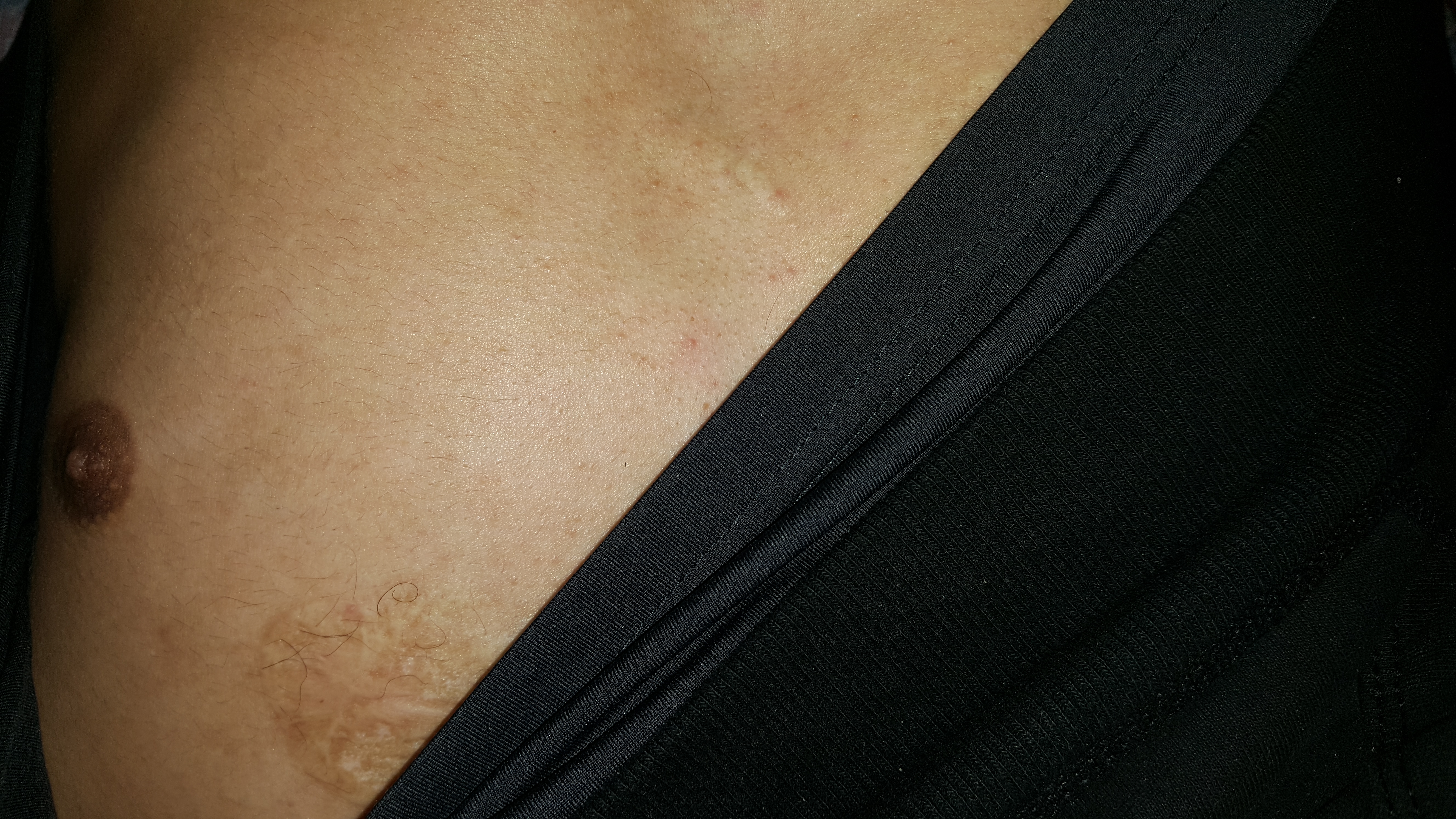 Image of burn injuries inflicted by Dr. Bouazza - Blow torch and cast iron bar