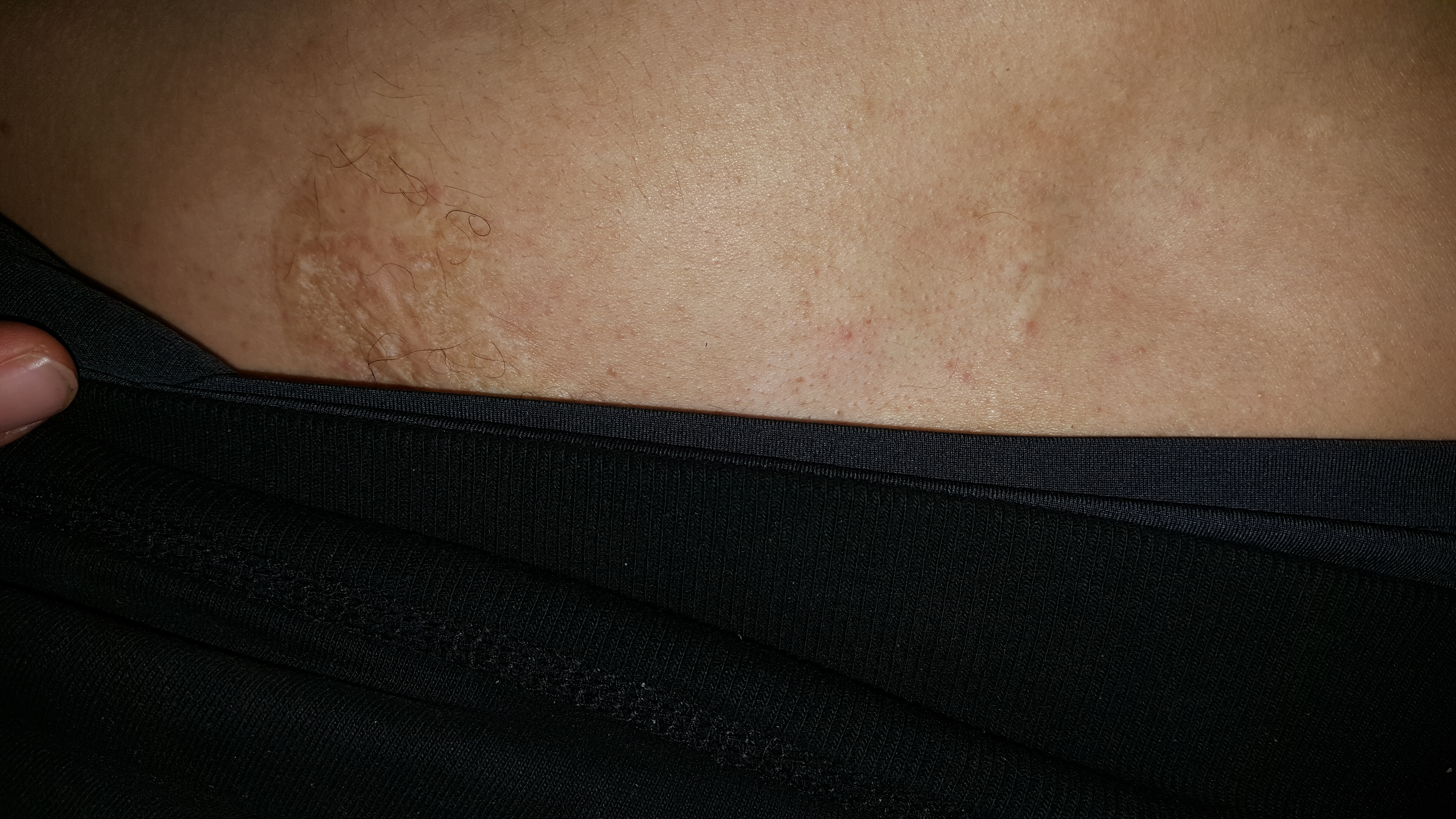 Another image of burn injuries inflicted by Dr. Bouazza - Blow torch and cast iron bar